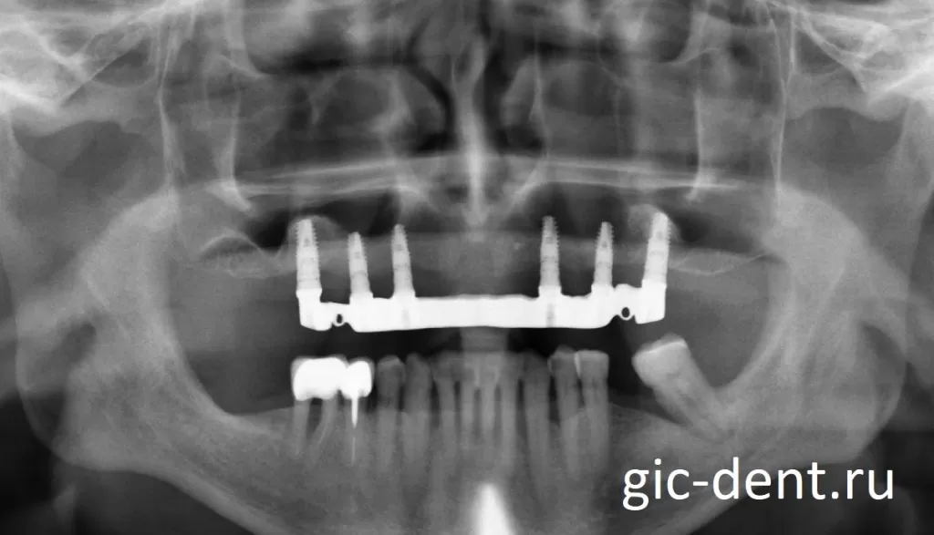 При выраженной атрофии в области жевательных зубов, устанавливаются имплантаты для фиксации балки только во фронтальном отделе